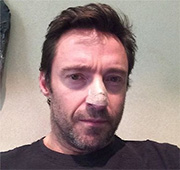 Hugh Jackman operato al naso per un tumore della pelle